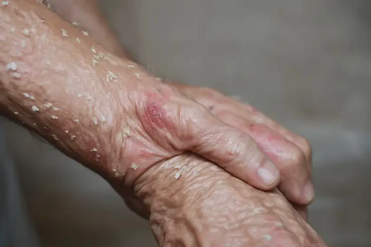 高齡老人身上經(jīng)常起濕疹可以徹底自愈嗎(圖4)