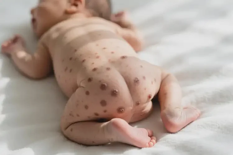 新生兒屁股經常起濕疹可以徹底自愈嗎(圖1)