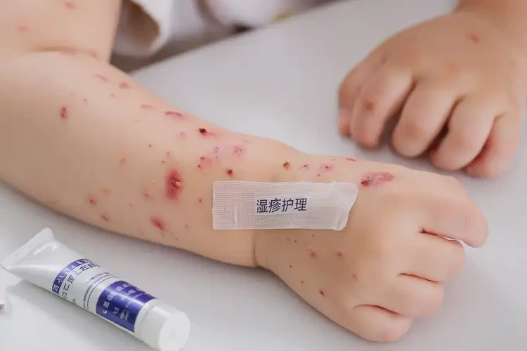 少兒四肢經常起濕疹不管它會自己痊愈嗎(圖4)