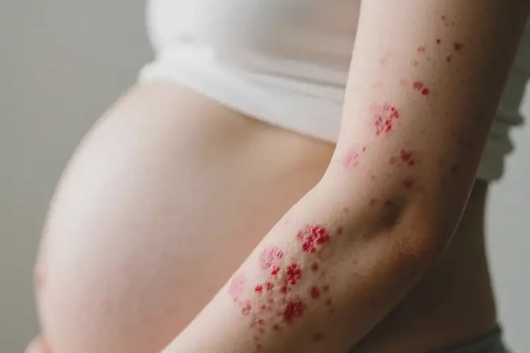 孕婦手臂經(jīng)常長(zhǎng)濕疹不管它會(huì)自己自愈嗎(圖4)