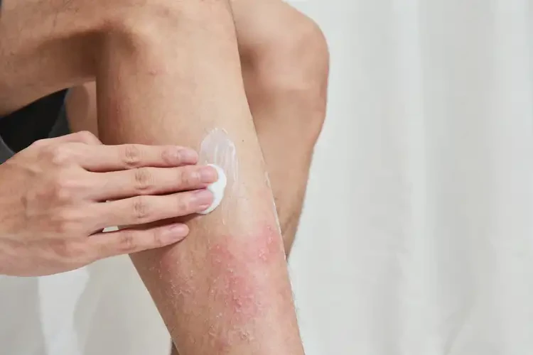 青年人小腿長濕疹能不能徹底自愈(圖1)