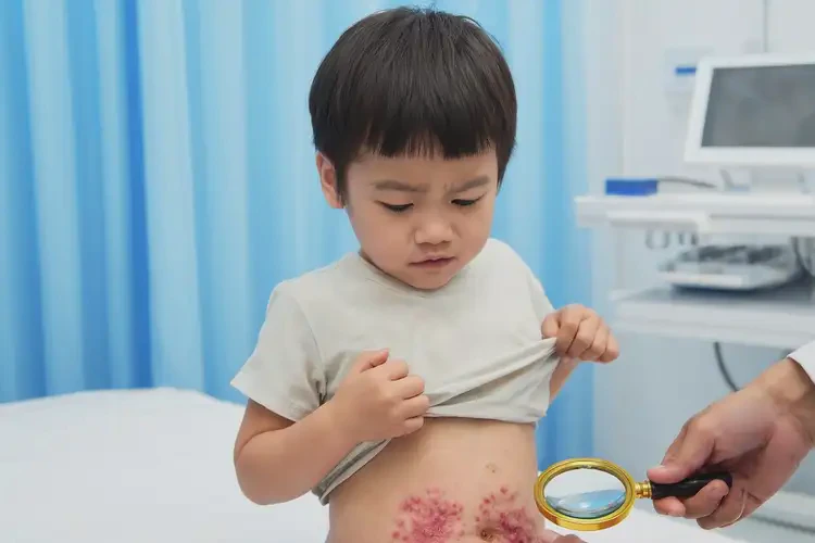 孩子肚子上起濕疹能夠徹底治愈嗎(圖4)