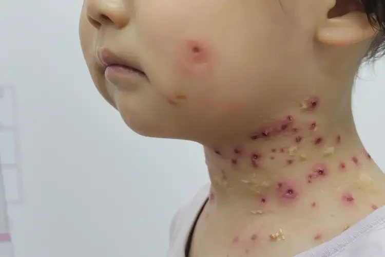 孩子脖子上經(jīng)常起濕疹能靠自己自愈嗎(圖3)