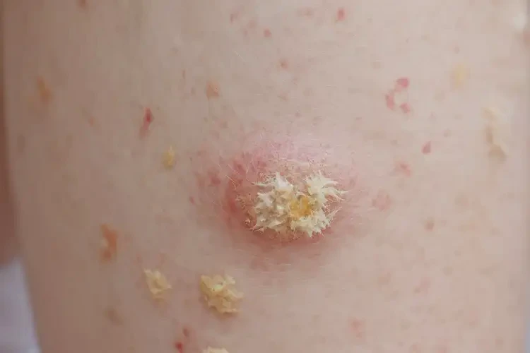 兒童大腿起濕疹可不可以徹底自愈(圖3)