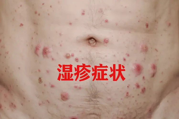 男性肚子上經(jīng)常長濕疹能夠徹底治愈嗎(圖4)