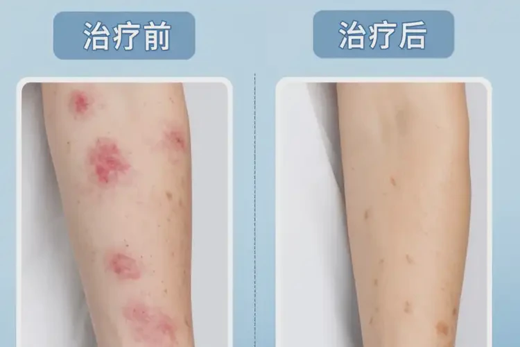 女生小腿長濕疹不管它會自己好嗎(圖1)