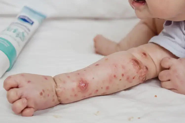 嬰兒四肢出濕疹不管它會自己好嗎(圖3)