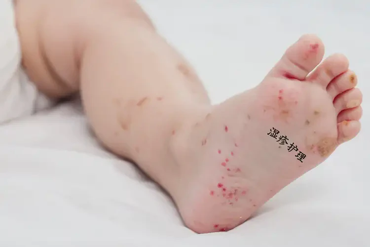 婴幼儿脚上出现湿疹能靠自己自愈吗(图4)