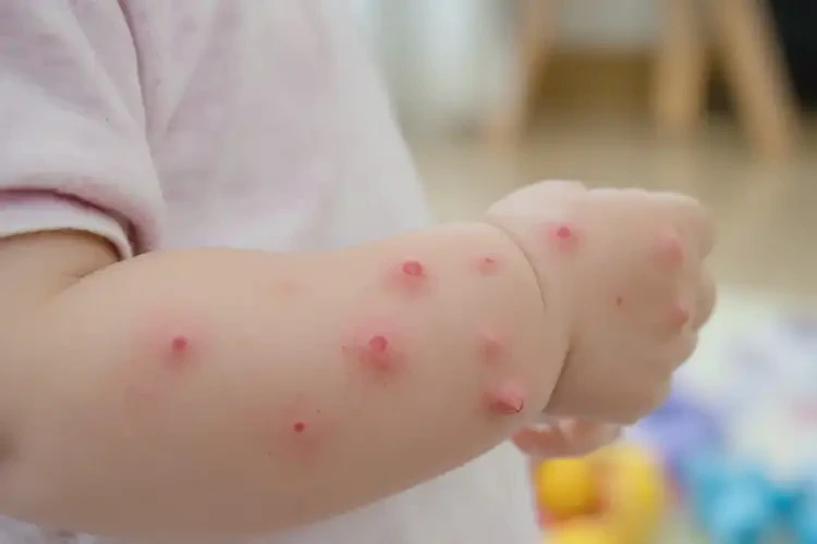 小孩屁股出現(xiàn)濕疹能夠徹底治愈嗎(圖4)