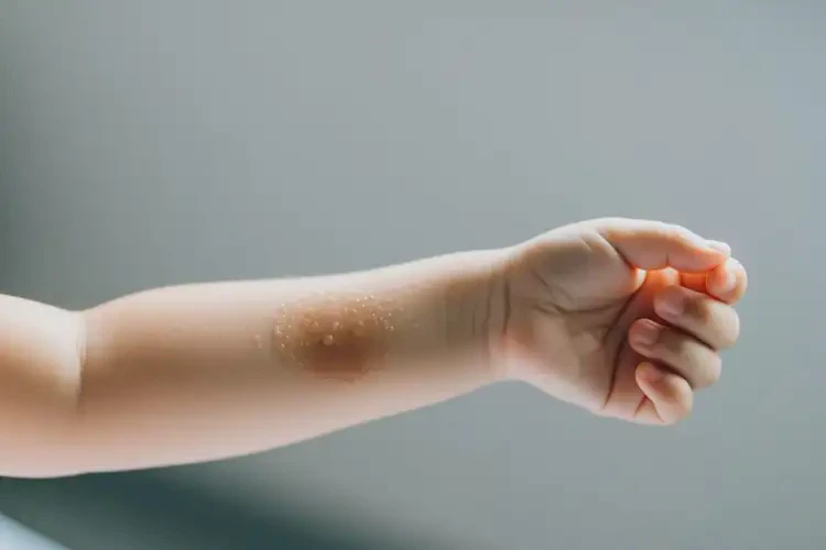 小孩手臂經(jīng)常起濕疹可以徹底自愈嗎(圖1)