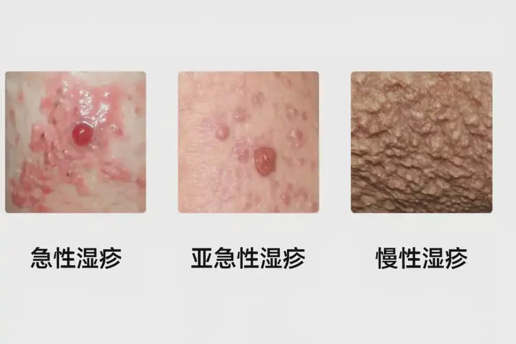 青年人腳上偶爾長(zhǎng)濕疹不管它會(huì)自己痊愈嗎(圖3)