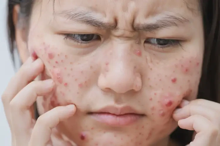 產(chǎn)婦臉上經(jīng)常起濕疹可以徹底自愈嗎(圖4)