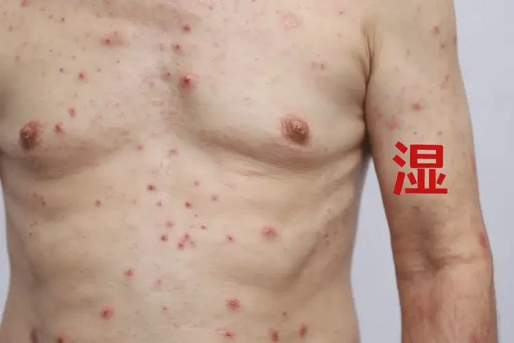 男人四肢出現(xiàn)濕疹能徹底自愈嗎(圖4)