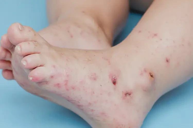 小兒腳上長濕疹能徹底自愈嗎(圖4)