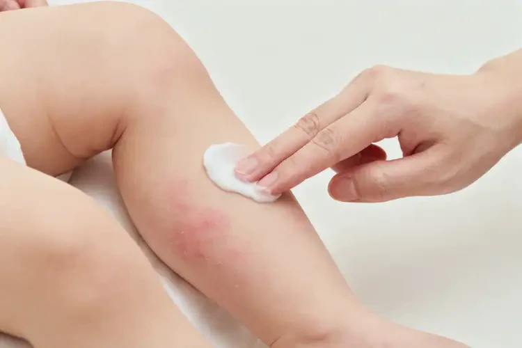 嬰兒小腿上起濕疹可不可以徹底自愈(圖3)