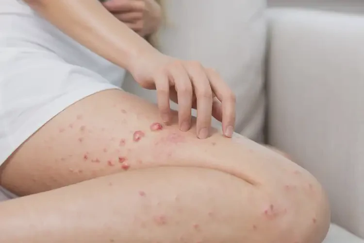 孕婦小腿容易起濕疹能夠徹底治愈嗎(圖4)