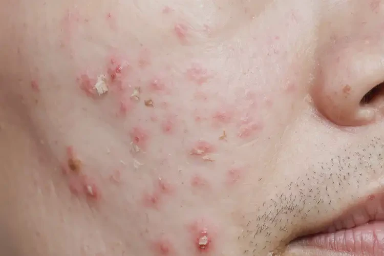 老人屁股上出濕疹可不可以徹底自愈(圖3)