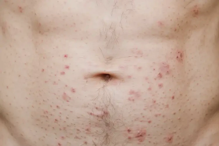 男性肚子上偶爾起濕疹不管它會自己痊愈嗎(圖4)