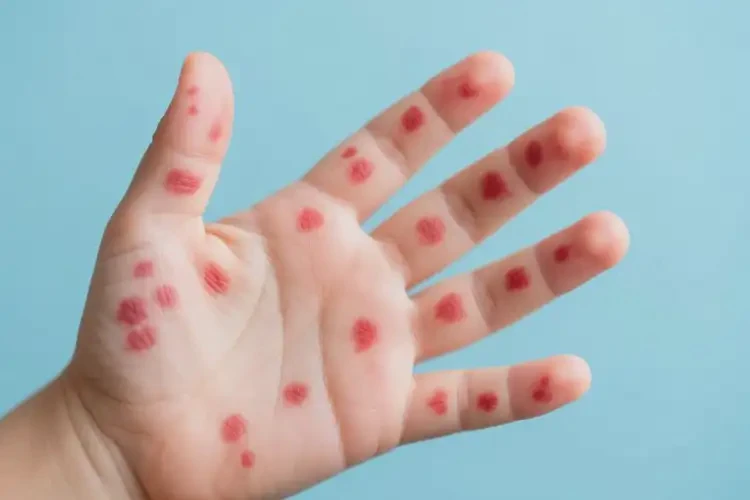 小孩手上起濕疹可以徹底自愈嗎(圖4)