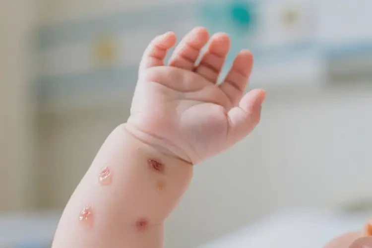 嬰兒手臂上有濕疹不管它會(huì)自己好嗎(圖2)