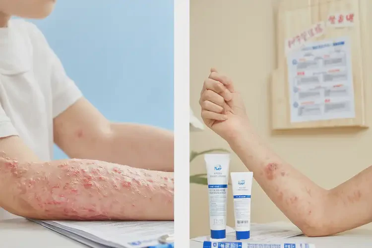 少兒身上有濕疹可不可以徹底自愈(圖1)