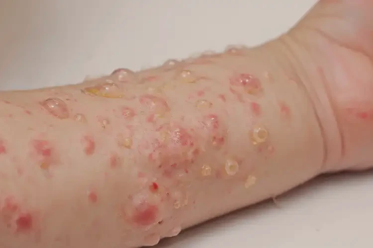 少兒手臂容易起濕疹不管它會(huì)自己好嗎(圖2)