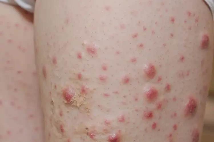 小孩大腿上容易長濕疹能徹底自愈嗎(圖4)