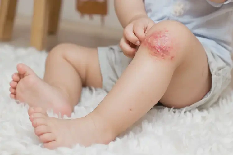 幼兒大腿上起濕疹不管它會自己痊愈嗎(圖4)