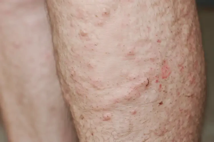 老年人小腿容易起濕疹不管它會自己好嗎(圖4)