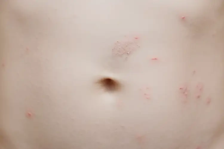 小學(xué)生肚子上容易長(zhǎng)濕疹不管它會(huì)自己好嗎(圖4)