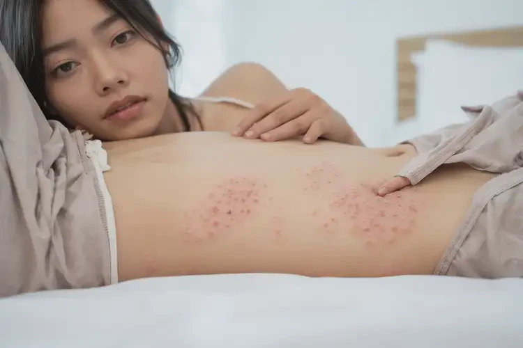 女人肚子偶爾起濕疹可不可以徹底自愈(圖4)