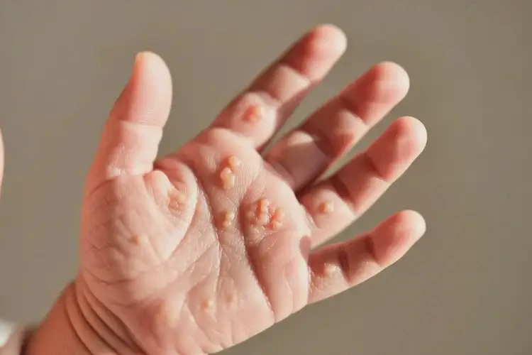 新生兒手上出現(xiàn)濕疹可以徹底自愈嗎(圖3)