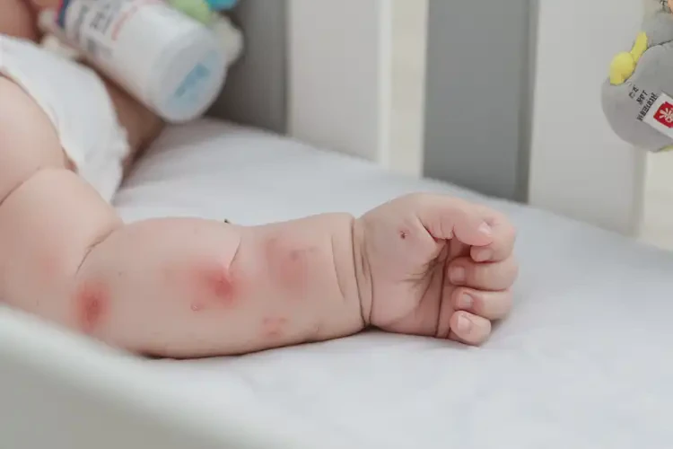 寶寶手臂上容易起濕疹能靠自己自愈嗎(圖3)