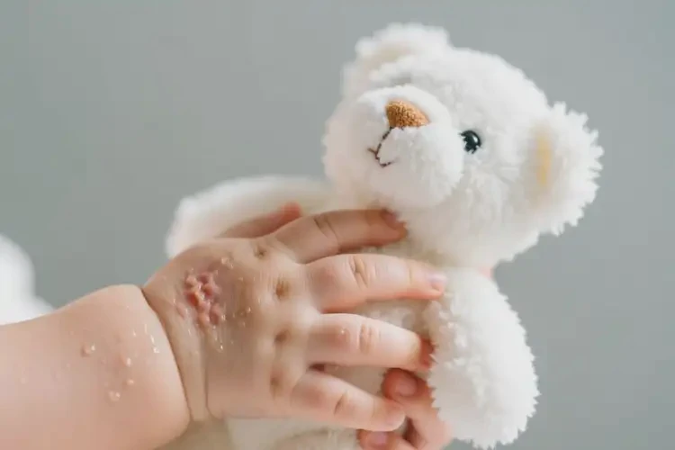 嬰兒手上經(jīng)常長(zhǎng)濕疹能徹底自愈嗎(圖2)