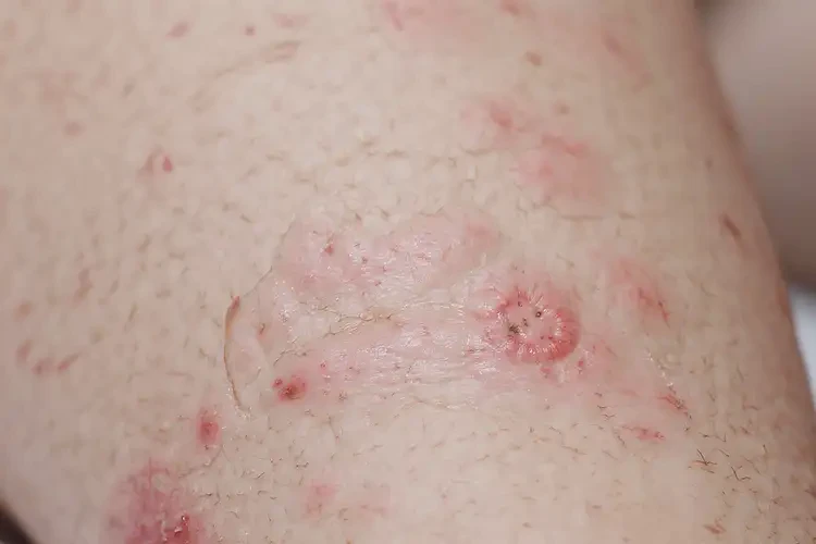 小孩小腿上經(jīng)常長濕疹能徹底自愈嗎(圖4)