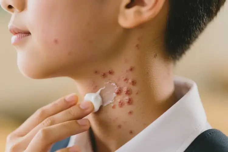 中学生脖子出现湿疹能靠自己自愈吗(图3)