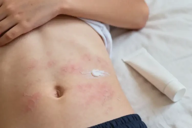 中學生肚子有濕疹能夠徹底治愈嗎(圖3)