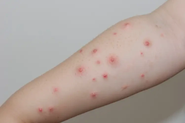 孩子屁股上經(jīng)常長(zhǎng)濕疹不管它會(huì)自己自愈嗎(圖4)