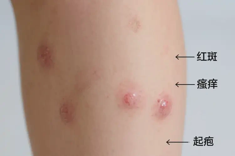少兒小腿經(jīng)常長(zhǎng)濕疹不管它會(huì)自己好嗎(圖4)