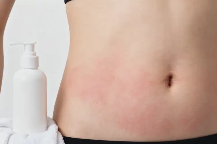 女生肚子容易長濕疹不管它會自己痊愈嗎(圖1)