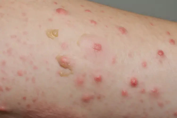 小學生全身有濕疹不管它會自己好嗎(圖3)