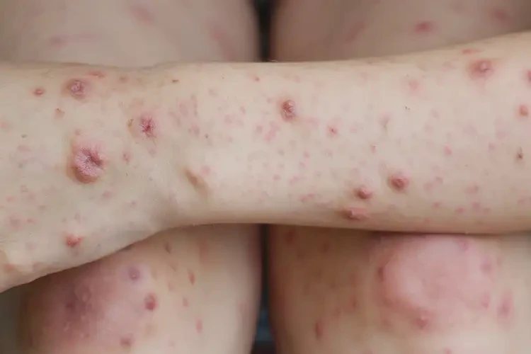 青少年四肢長濕疹不管它會自己自愈嗎(圖4)