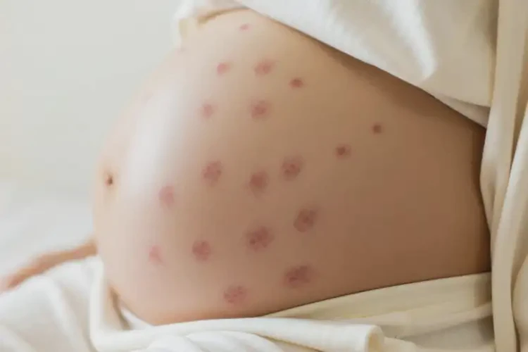 孕婦肚子上經(jīng)常起濕疹不管它會(huì)自己好嗎(圖3)