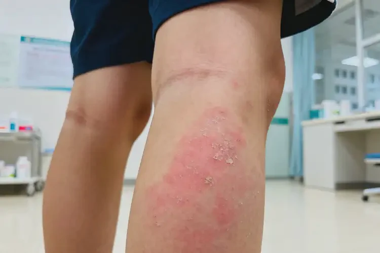 青少年小腿起濕疹可以徹底自愈嗎(圖4)