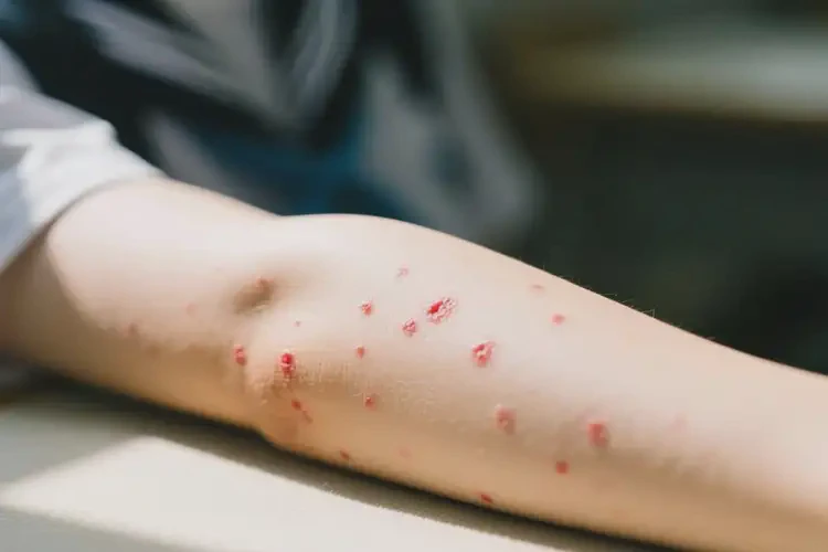 大學(xué)生手臂上偶爾起濕疹能徹底自愈嗎(圖3)