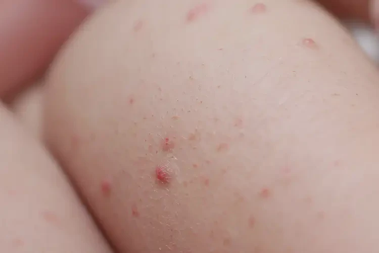 新生儿小腿出湿疹能彻底自愈吗(图4)