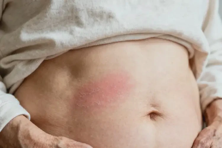 老年人肚子長濕疹不管它會自己自愈嗎(圖2)