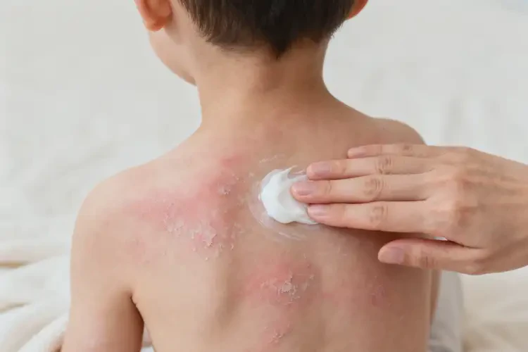 孩子全身偶爾長(zhǎng)濕疹不管它會(huì)自己痊愈嗎(圖4)