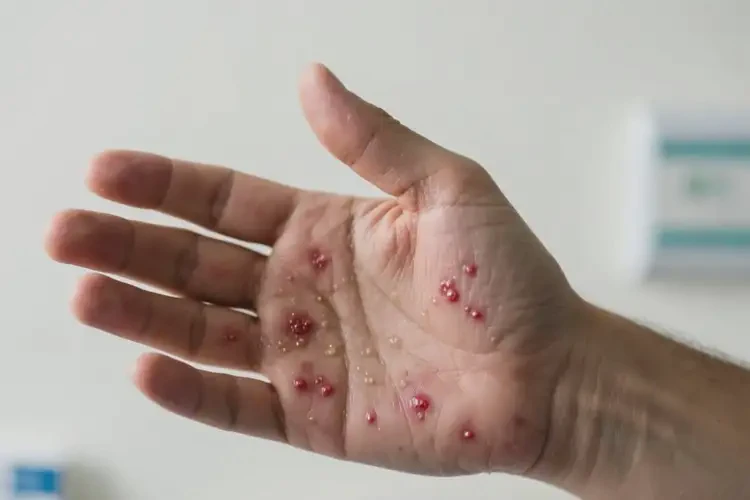 男人手上起濕疹能夠徹底治愈嗎(圖4)