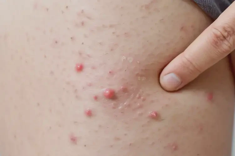 孕婦小腿有濕疹能夠徹底治愈嗎(圖4)